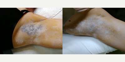 25-34 year old woman treated with miraDry - Sweat Test prior to miradry treatment and sweat test at 3 months on the left armpit