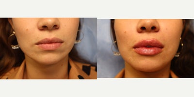 25-34 year old woman treated with Lip Fillers - Lip filler