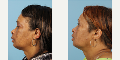 45-54 year old woman treated with Obagi Nu-Derm - 45-54 year old woman treated with Obagi Nu-Derm