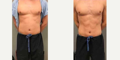 Emsculpt - This is just immediately after 4 treatments (the recommended amount to see the best results) the peak result is 6 weeks after treatment!Emsculpt is a non-invasive treatment that strengthens and builds muscle while burning away fat. Its a one of a kind treatment