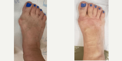 55-64 year old woman treated with Bunion Surgery - Right foot Bunion Deformity