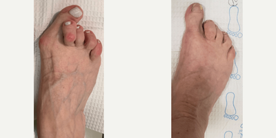 55-64 year old woman treated with Bunion Surgery - Right foot Bunion Deformity