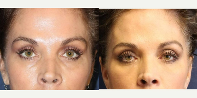 Tear Trough | Lower Eyelid Treatment with Bellafill - Bothered by her tear troughs and the beginning of lower eyelid bags that she felt were making her look tired, this woman did not want surgery but wanted something long lasting that would help her.  She chose to have Bellafill (also known as Artefill) placed under her eyes.  One syringe was literally air bushed onto each side using a cannula technique.