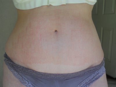 Fraxel Co2 For White Stretch Marks Review Realself