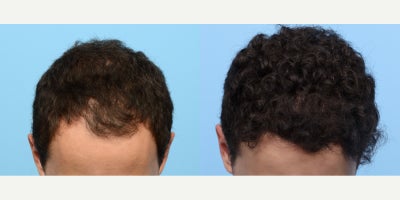 18-24 year old man treated with FUE Hair Transplant, Hair Transplant, Hair Loss Treatment, PRP for Hair Loss, PRP Injections - Remarkable hair restoration results one year after a 2,525 graft FUE hair transplant to Zone 1, performed by Dr. Wise, complemented by a PRP therapy session. This 22-year-old patient achieved a natural and fuller hairline, enhancing both appearance and confidence.