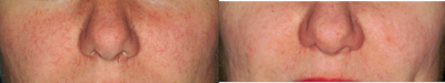 IPL treatment - Before and after treatment with IPL.