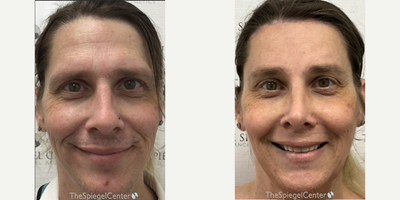 Man treated with Facial Fat Transfer, Cheek Augmentation, Forehead Reduction, Jaw Reduction - Man treated with Facial Fat Transfer, Cheek Augmentation, Forehead Reduction, Jaw Reduction