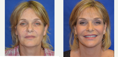 55-64 year old woman treated with Skin Tightening - This patient came in wanting to improve her overall appearance. After consulting with Dr. Ho, the patient elected to have a face/neck lift to tighten the skin, fat grafting to restore lost volume and laser skin resurfacing to improve texture and tone.