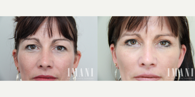 45-54 year old woman treated with Pelleve - Pelleve face and neck treatments were administered, four to six weeks apart, to tighten and smooth the patients skin and promote the growth of new collagen.