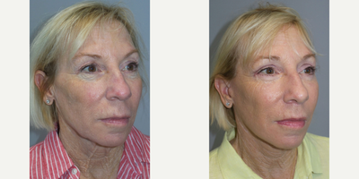55-64 year old woman treated with Facial - 55-64 year old woman treated with Facial