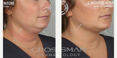 Woman treated with Nonsurgical Neck Lift - This is after only 2 non-invasive Evoke Neck & Evoke Face treatments. Evoke Neck & Evoke Face, by InMode, delivers radio frequency (RF) energy to the cheeks, neck, and jawline helping melt fat & tighten skin. Each treatment is only 30 minutes and completely pain-free.The RF energy penetrates deep into the subdermal layer, heating the Fibro Septal Network (FSN). With its ability to maintain a constant temperature, Evoke remodels the dermis and subdermal tissue to deliver more defined facial characteristics.