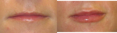 Juvederm - 
	This very nice woman in her mid 30's sought enhancement of her lips, particularly the disappearing upper lip. Juvederm has given her a more enhanced vermillion border in addition to more body the red portion of the lip
