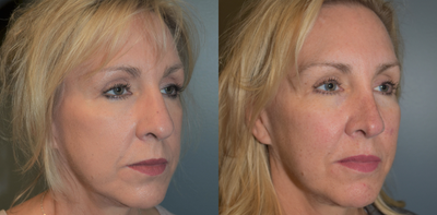 55-64 year old woman treated with Cheek Augmentation - This 57 year old woman felt her cheeks had become deflated over the years. She wanted a solution that would last longer than fillers, so she elected to have cheek implants placed. At the same time she had a rhinoplasty to refine the tip and narrow her nose. her results are shown one year after her surgery.