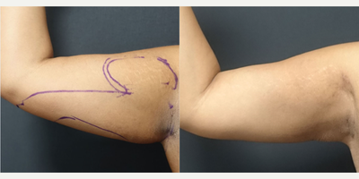 35-44 year old woman treated with Arm Lift - Arm Lift Surgery performed by Ozge Ergun, MD - 3 Months Post-Operative