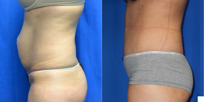35-44 year old woman treated with Tummy Tuck - 38 year old female 2 months after a tummy tuck and umbilical hernia repair. Selective undermining and progressive tension sutures were used. She has four children. Her preoperative weight was 152 lbs and her height was 5 feet 6 inches.