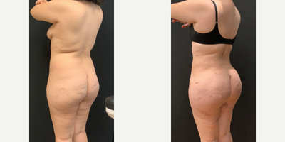 Cellfina, Renuvion - Woman treated with Cellfina, Renuvion