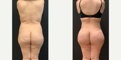 Cellfina, Renuvion - Woman treated with Cellfina, Renuvion