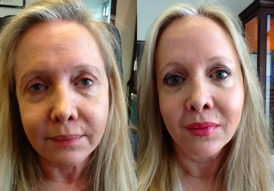 65-74 year old woman treated with Botox and fillers - 2 weeks post Botox and facial filler injection.