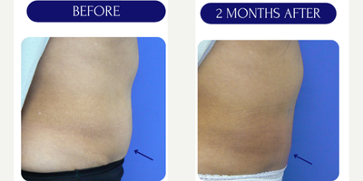 35-44 year old woman treated with Lipodissolve - lipodissolve injections