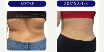 35-44 year old woman treated with Lipodissolve - lipodissolve injections