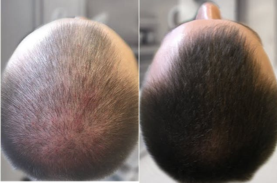 18-24 year old man treated with Mesotherapy - Scalp mesotherapy with combing medication.