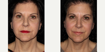 45-54 year old woman treated with Microneedling RF - This client has had AGNES RF to the periorbital region and jawline. She has had an excellent response, with smoothing and tightening, improvement in the tear trough, and reduction in jowl size. AGNES RF allows us to dissolve some of the unwanted fat cells selectively in regions where this is a goal, which is not possible with most other RF microneedling devices.