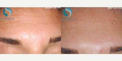 35-44 year old woman treated with Fraxel Repair - Improvement of lines at rest after Botox to the forehead.