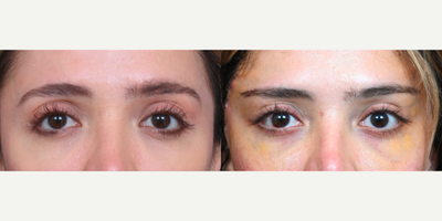 35-44 year old woman treated with Brow Lift, Canthoplasty - 1 week post-op temporal lift, canthoplasty, brow lift