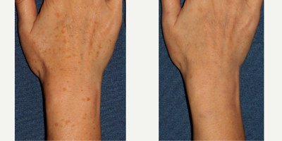 45-54 year old woman treated with PicoWay - Before and after of woman's hand and arm being treated to reduce brown spots.