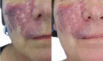 VBeam Treatment for Port Wine Stain - Although port wine stains affect one in every 300 babies born, there are often many uncertainties regarding what causes the condition. The first photo was taken before this patients VBeam Perfecta treatment and the after was taken six weeks post-treatment. With significant lightening of the lesion, the stain has already gone from purple to red.