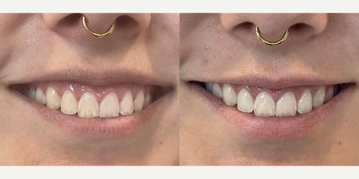 18-24 year old woman treated with Botox for Gummy Smile - Neuromodulator for gummy smile