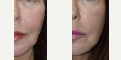 55-64 year old woman treated with Sculptra - Patient had severe trauma to left side of the face with corresponding loss of facial tissue, collagen and fat.  Using Sculptra we were able to create symmetry in the facial structure by adding volume.  Sculptra stimulates the production of your own collagen so lasts 3 years or more.