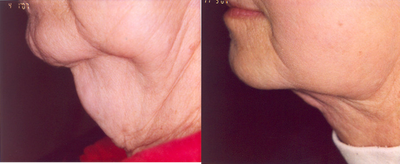 Lipodissolve and CoolSculpting - 
	Lipodissolve and CoolSculpting
