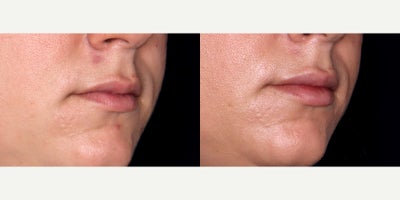 33 year old woman treated with Lip Fillers (Restylane Kysse) - 33 year old woman treated with Lip Fillers (Restylane Kysse) Photos depict before and 1 month after 1 syringe to lips.