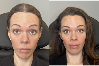 25-34 year old woman treated with Xeomin - 55 units:Glabella: 20 unitsFrontalis: 20 units Crows Feet: 15 units