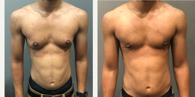 25-34 year old man treated with FTM Chest Masculinization Surgery - 25-34 year old man treated with FTM Chest Masculinization Surgery