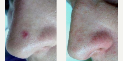 Woman treated with Excel V - Woman treated with Excel V