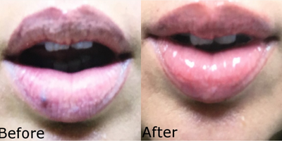 Woman treated with Excel V - Woman treated with Excel V