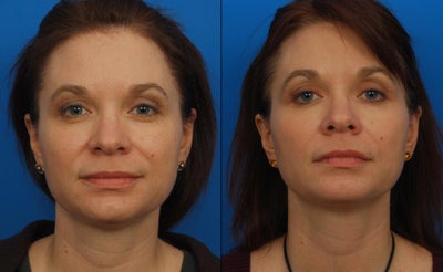 Ultherapy - 
	Ultherapy
