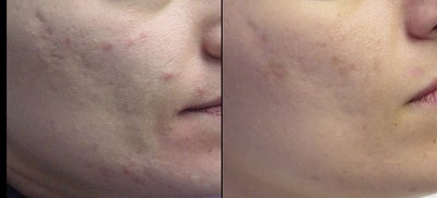 Aesthera Isolaze for acne - This 29 year old patient had 2 treatments with the Isolaze device for acne with good improvement.