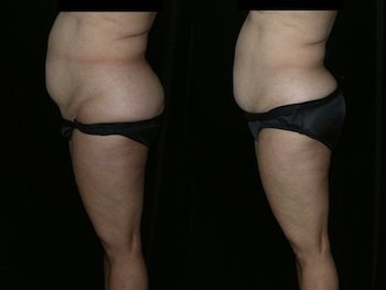 Zerona - 
	64 year old woman before and after Zerona. She lost 5.75 inches.
