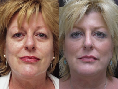 Non-surgical face lift - 
	This patient began using New Youth Cosmeceuticals twice a day to tighten her skin, increase clarity, reduce pore size, and reduce pigmentation problems. This was followed by two sessions of Sculptra injections to replace lost volume in the hollows under the eyes, the cheeks, nasolabial creases and chin areas. Sculptra injections in the temporal area account for the elevation of the brow.
