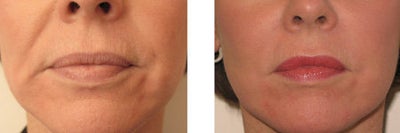 Juvederm and Botox around mouth - 
	Before and after liquid face lift of mouth area with the filler Juvederm and with Botox
