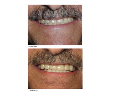 Lumineers - 
	Patient was concerned that he had worn his teeth down and didn&#39;t like the way they looked. We adjusted his bite and placed Lumineers on his upper and lower teeth to make them look the way his natural teeth once did.

