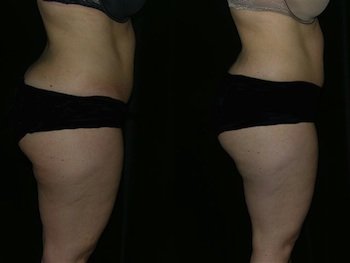 Zerona - 
	33 year old female before and after 6 zerona treatments.
