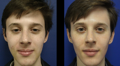 Fraxel Therapy - 
	male patient before &amp; after Fraxel Laser Therapy.

