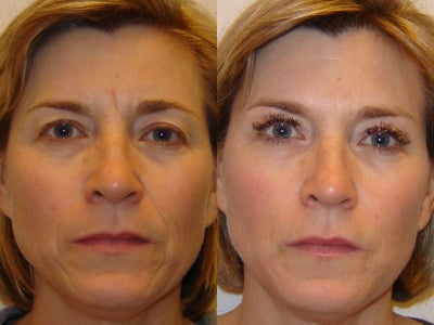 Botox/Fillers - 
	She had two cc Perlane, 1cc Restylane and 1cc Botox.
