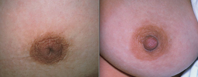 Nipple Surgery - 
	Before and After
