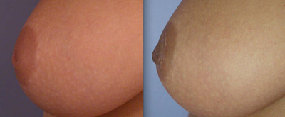 Nipple Surgery - 
	Before and After Nipple Surgery
