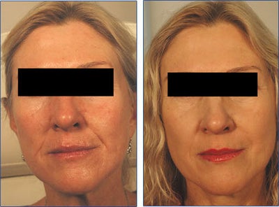 Restylane for Laugh Lines Before and After Photo - 
	Patient was concerned about smile lines at the sides of nose and mouth. Patient received 2 cc&#39;s of Restylane to add volume and correct the lines.
